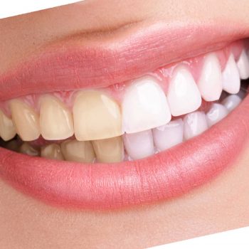 white-teeth